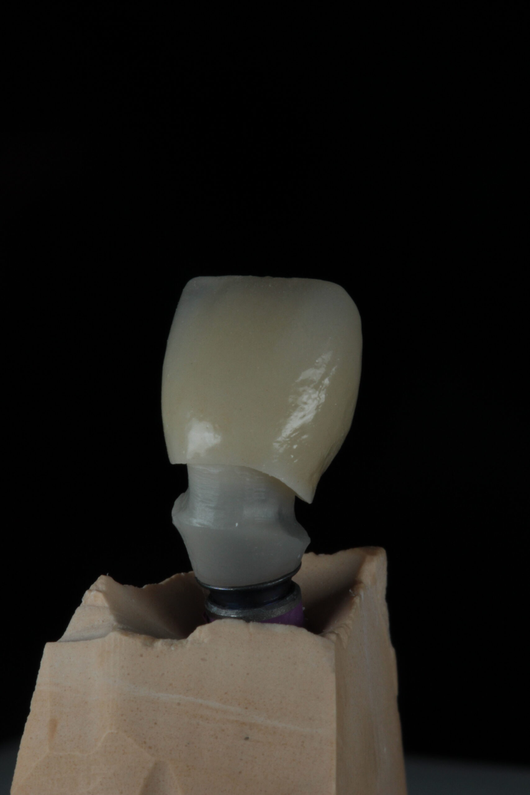 korona készítés fogkorona cirkón korona gáspár dental