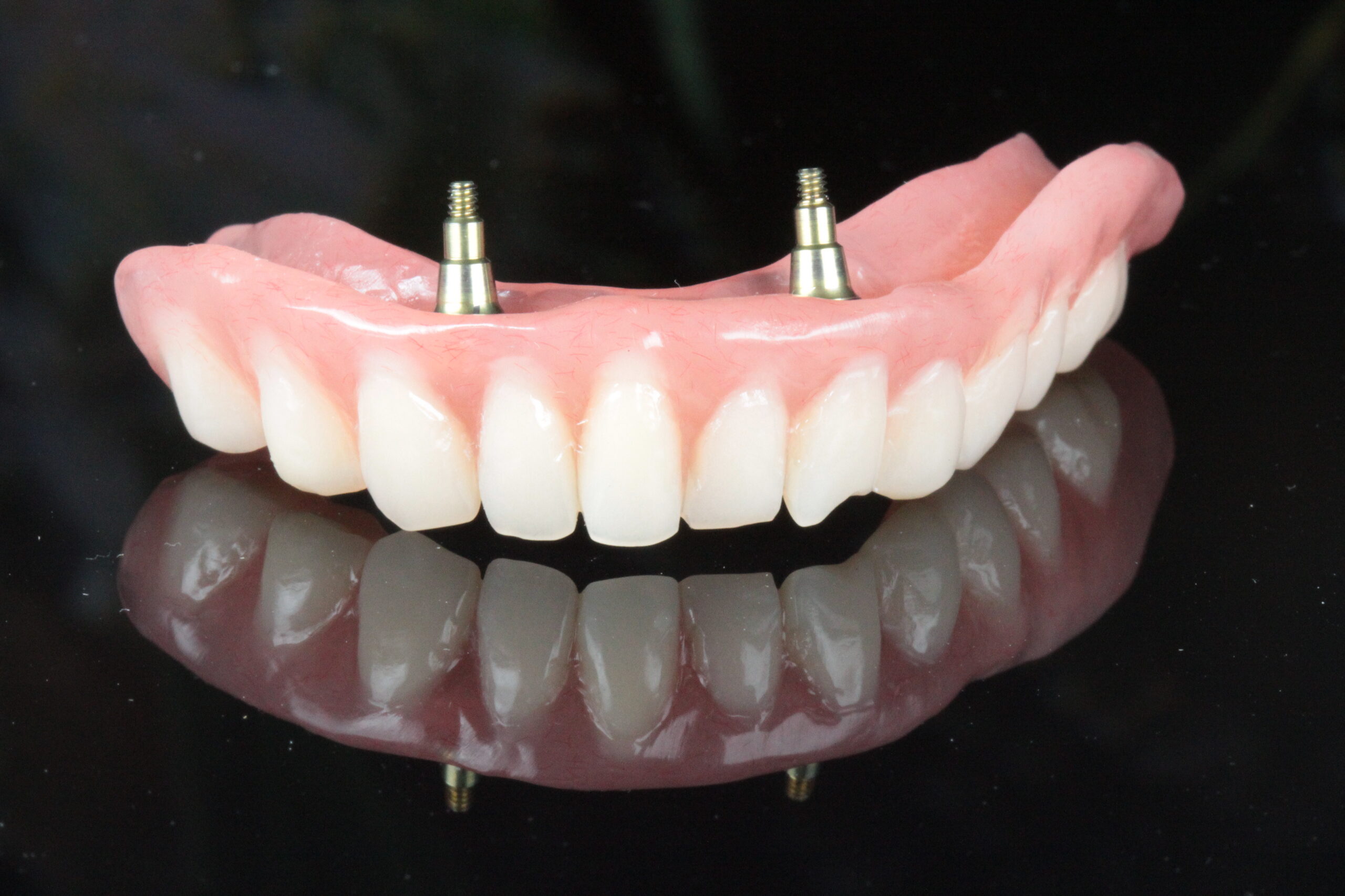 Stabil fogsor, fogsor stabilizálás, implantátum és fogsor, rögzített protézis, gáspár dental, gaspar medical center