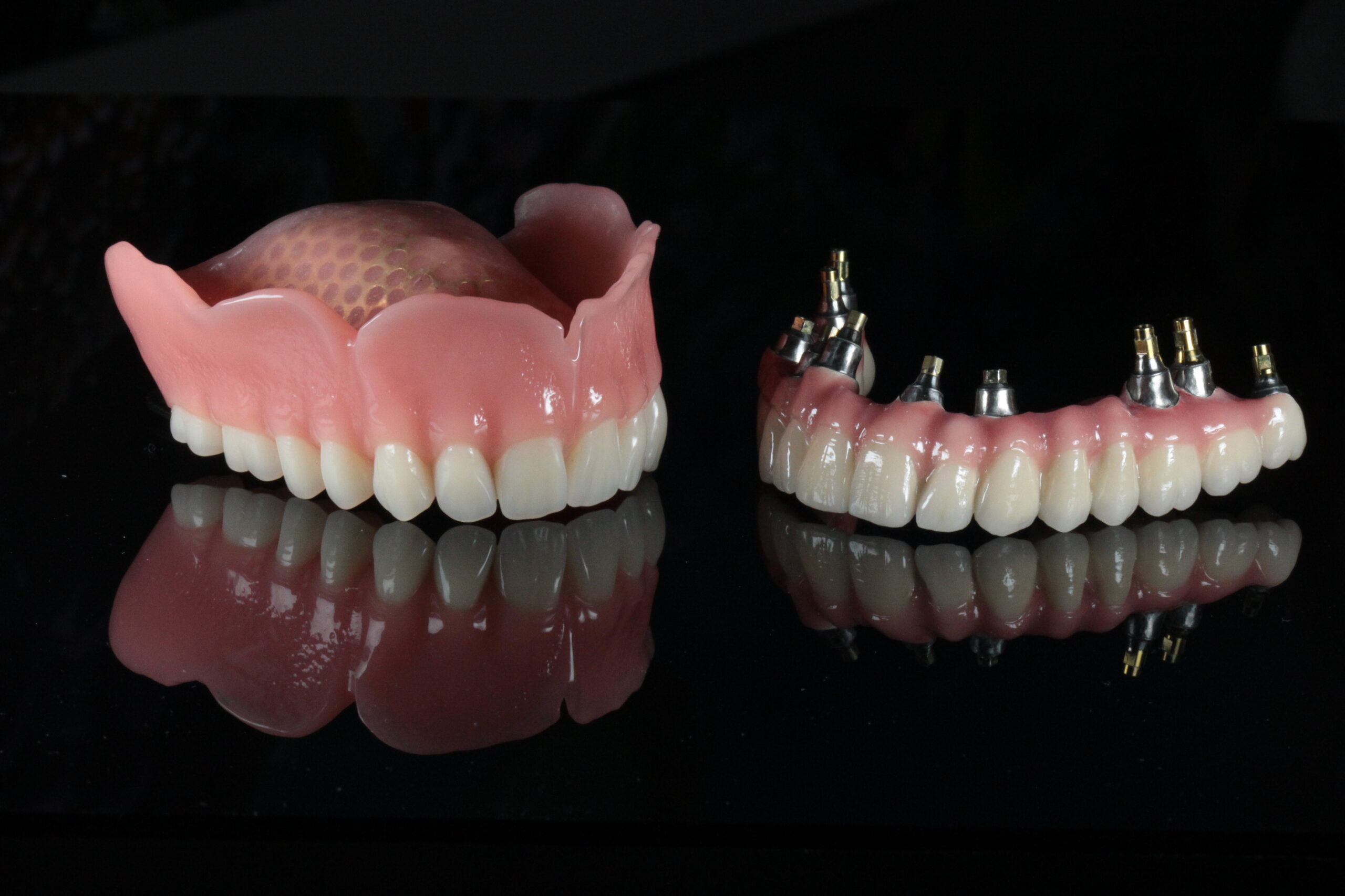 implantátum beültetés, implantátum fogsor, fogimplantátum, Stabil fogsor, fogsor stabilizálás, implantátum és fogsor, rögzített protézis, gáspár dental, gaspar medical center