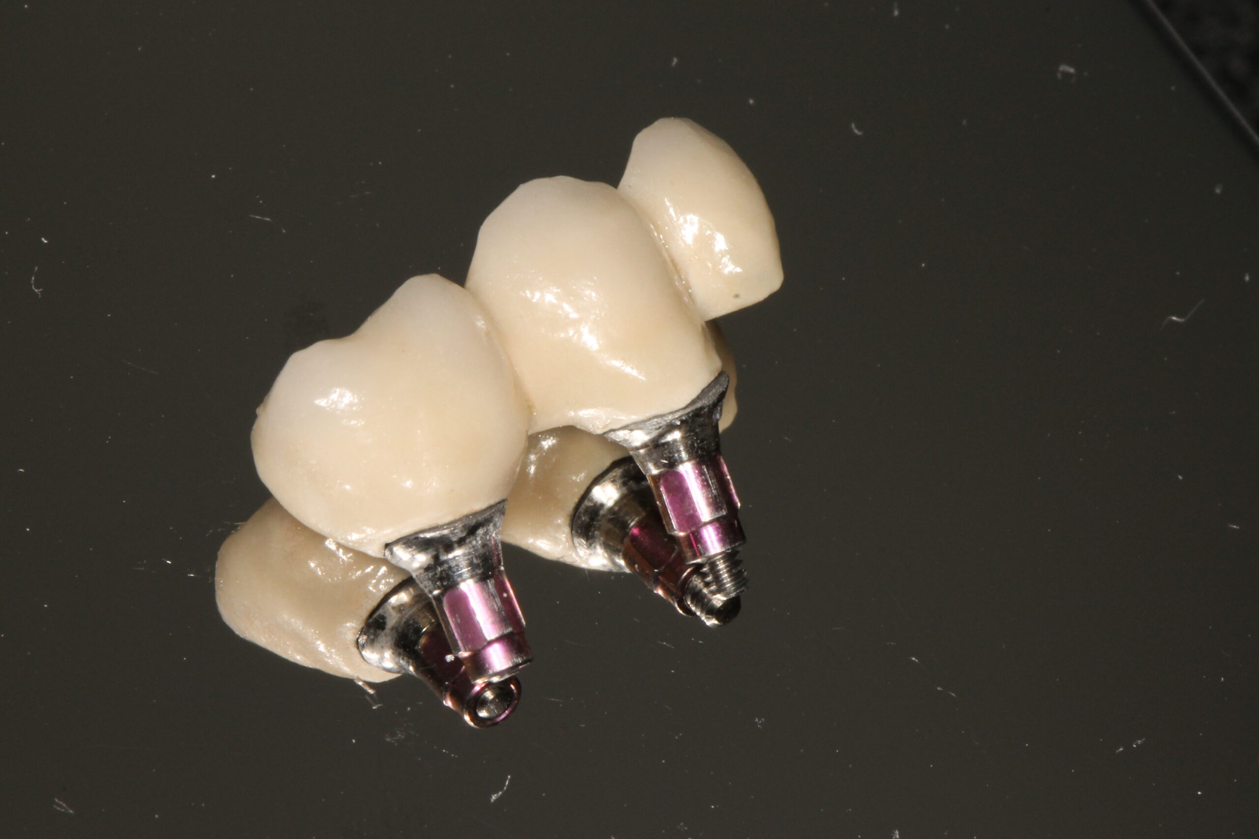 Implantátum műgyökér fogsor körhíd Dr Tóth-Gáspár Máté Gáspár Dental Gaspar Medical Center