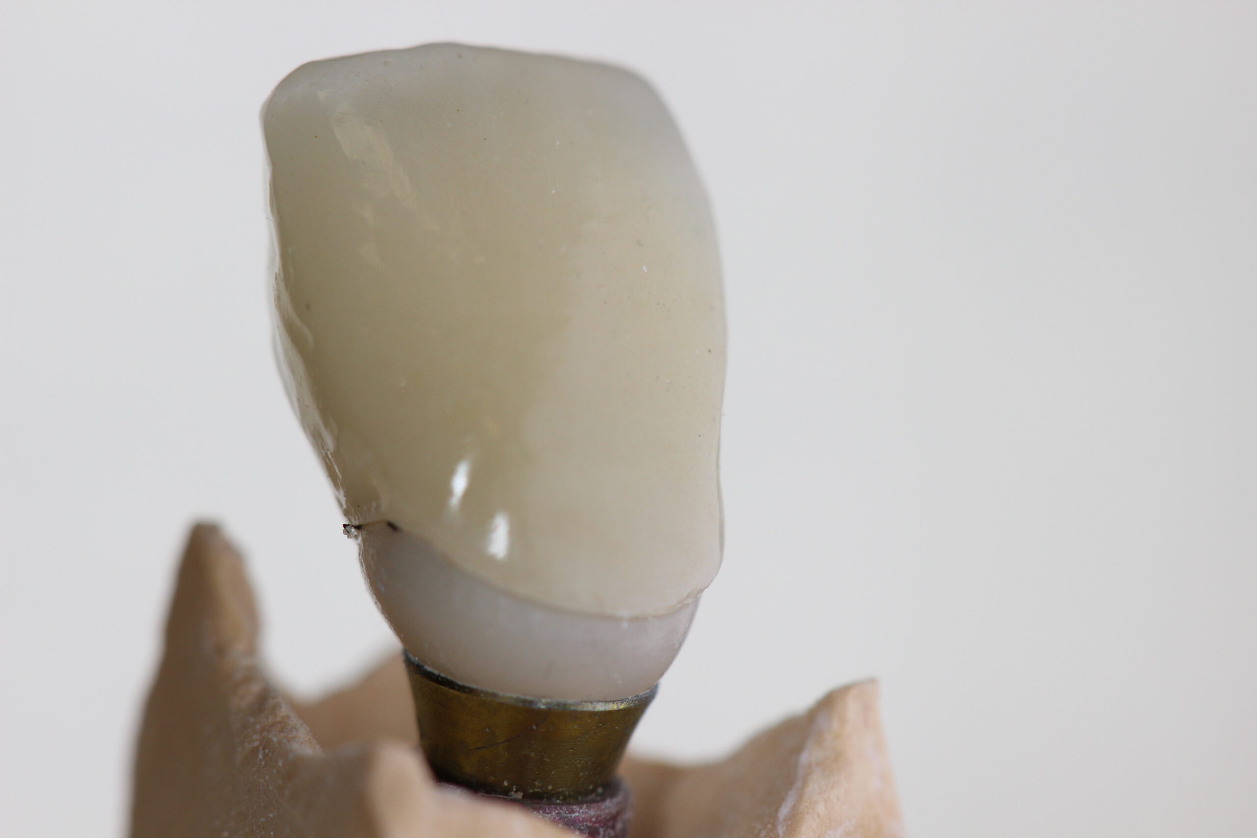 korona készítés fogkorona cirkón korona gáspár dental csapos fog készítés