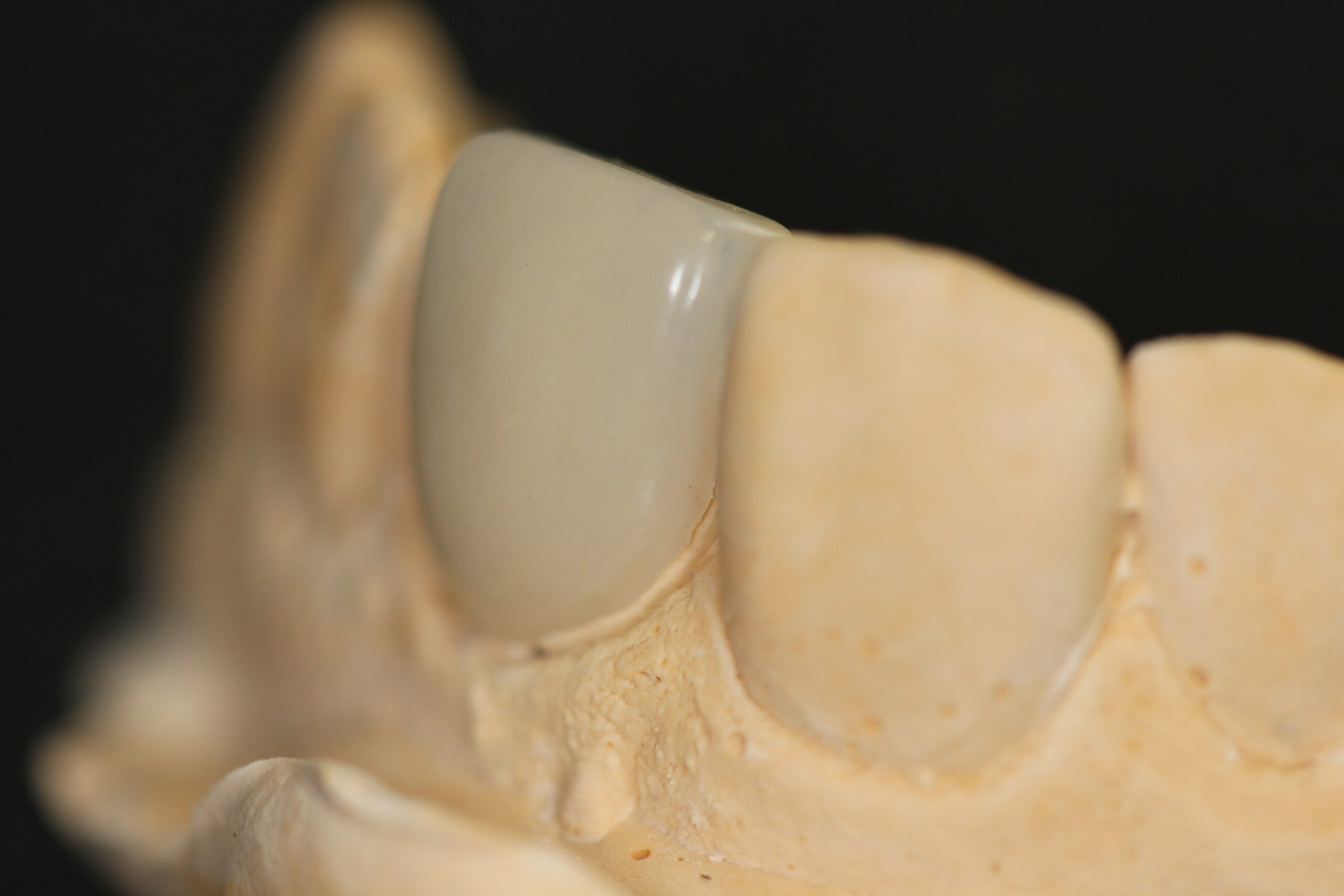korona készítés fogkorona cirkón korona gáspár dental inlay onlay betét
