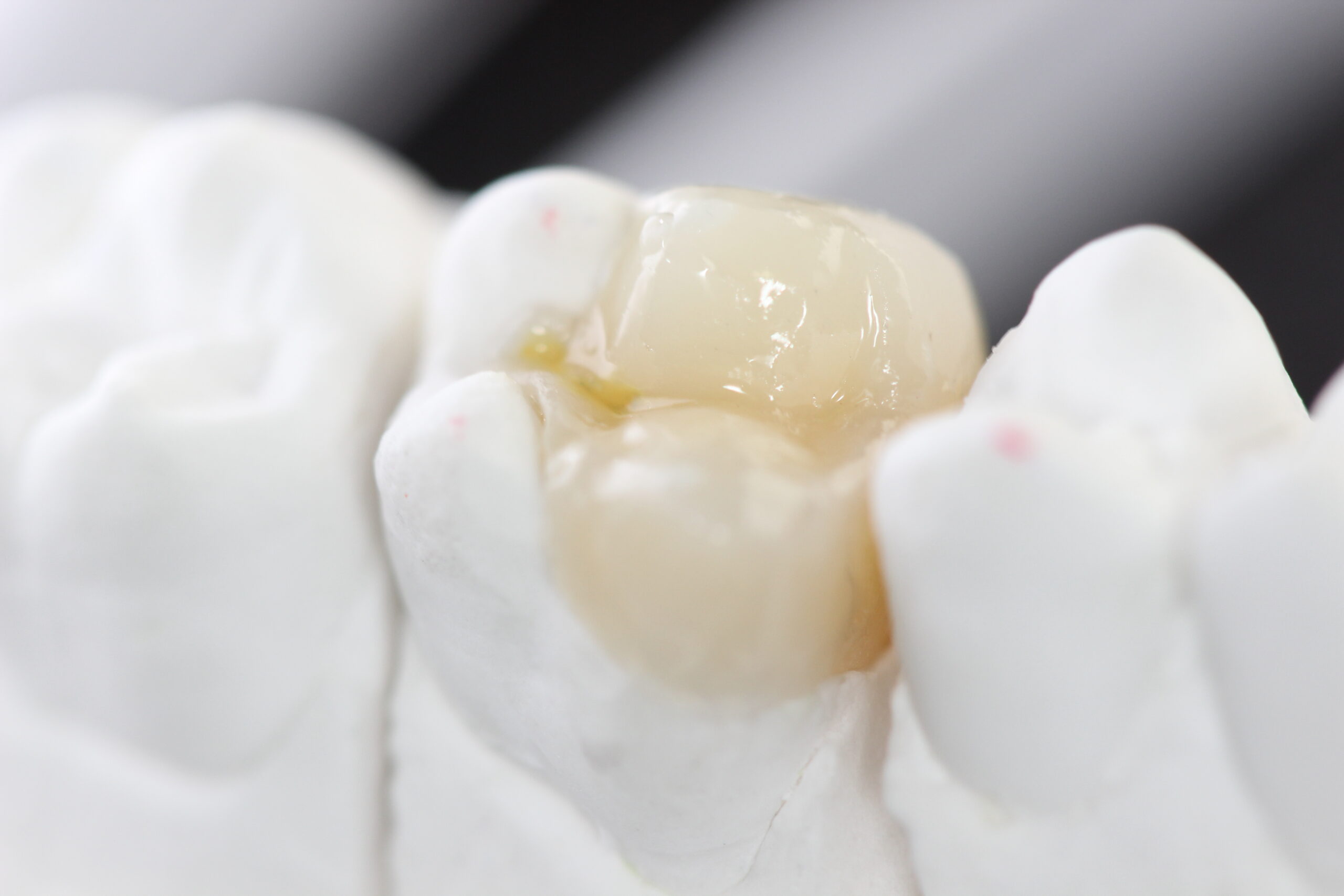 korona készítés fogkorona cirkón korona gáspár dental inlay onlay betét