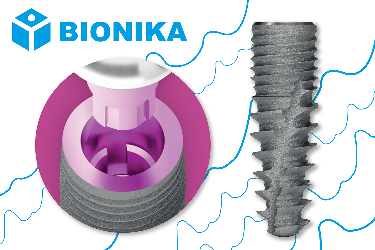 cortilog_implant_gaspardental_50szazalekakcio_2021marcius